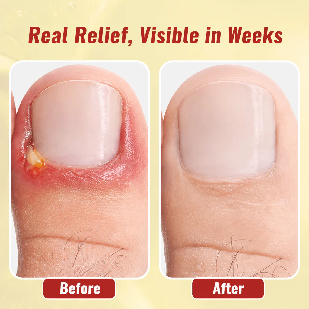 NailFortify™ — Soothe Painful Ingrown Toenails and Fungal Damage at Home - Image 4