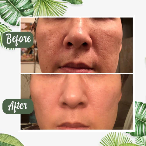 PurifyMist™ — Unleash Clear, Radiant Skin That Glows with Confidence - Image 5