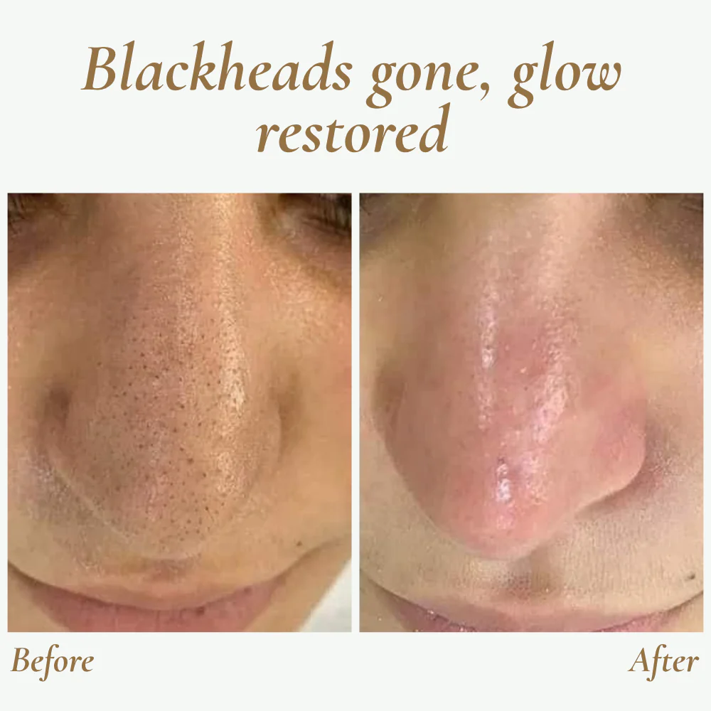 SkinPulse™ - Professional Ultrasonic Skin Cleansing - Image 3